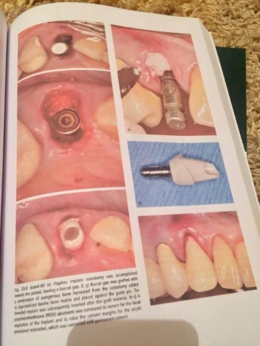Dental Implant Complications J.Froum,2nd edition 2016