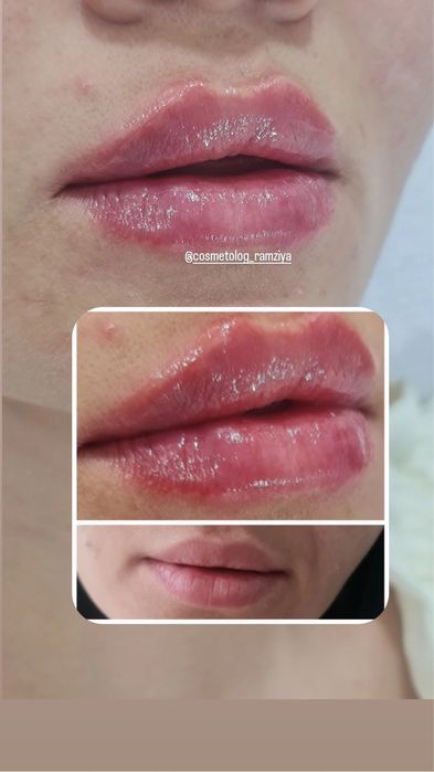 Губки , филлер, ботокс . Качественно!