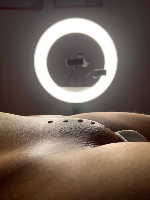 Эластомерная депиляция