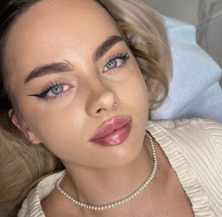 Obtine buze voluminoase si frumos conturate cu acid hialuronic