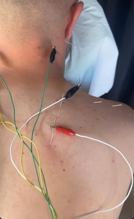 Recuperare Neurologica,Chiropractica,Acupunctura,Cupping(Ventuze)