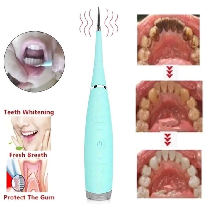 Нов ултразвуков апарат за почистване на зъбен камък