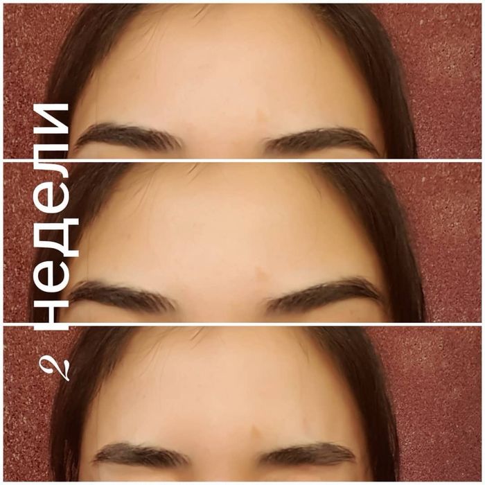 Ботокс | Косметолог Ташкент |