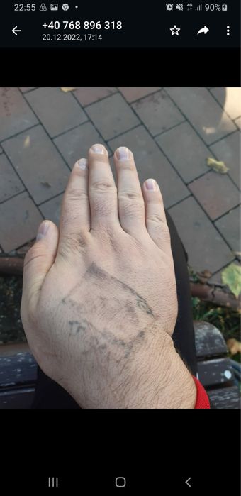 Laser scoatere tatuaj corporal si facial