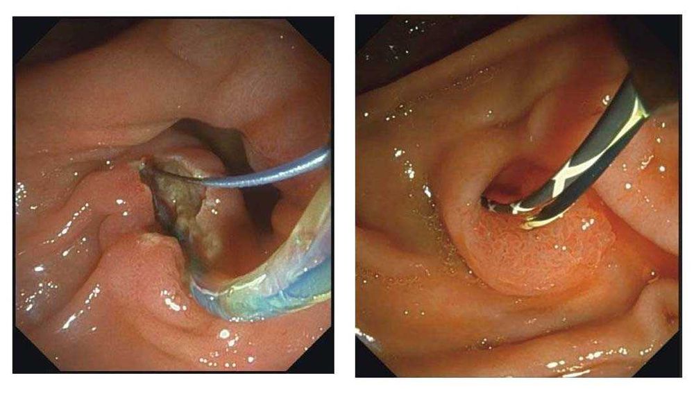 ВидеоДуоденоскоп SonoScape