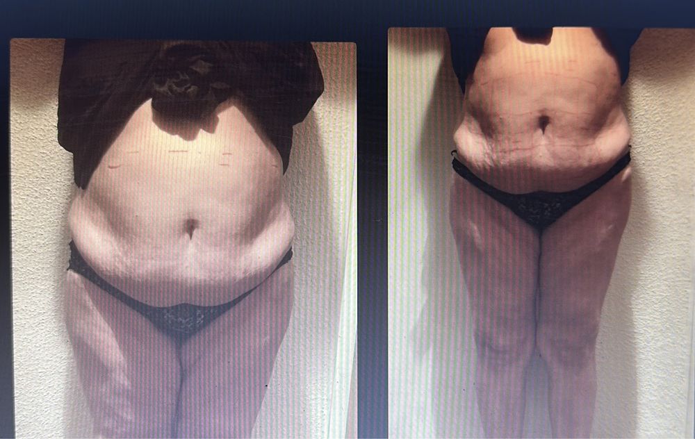 Liposonix Aparat remodelare