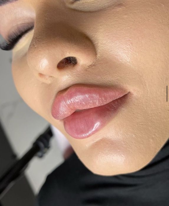 Obtine buze voluminoase si frumos conturate cu acid hialuronic