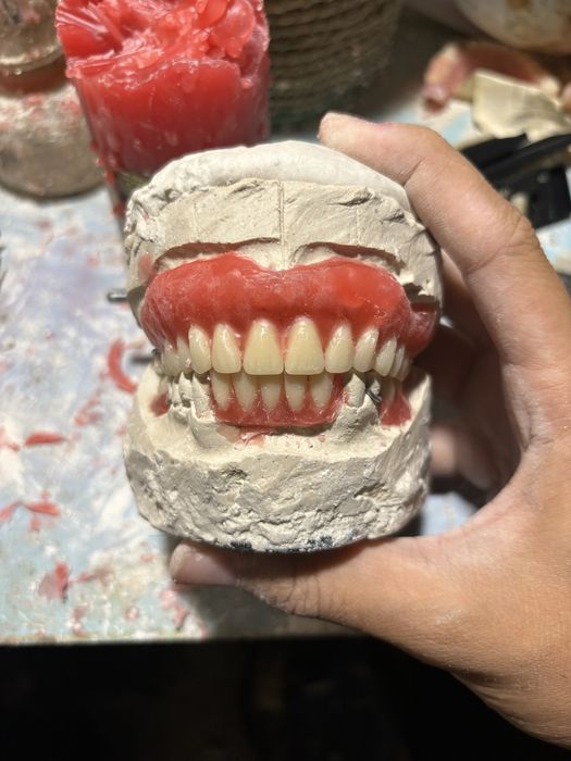 Изготовление сьемных протезов