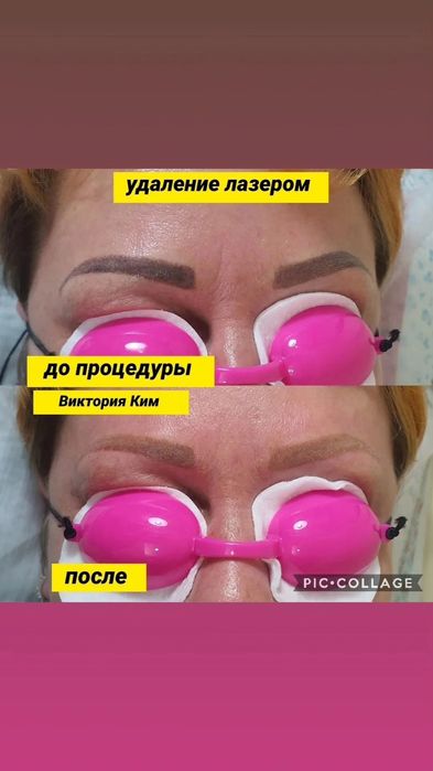 Удаление татуажа лазером 5000т