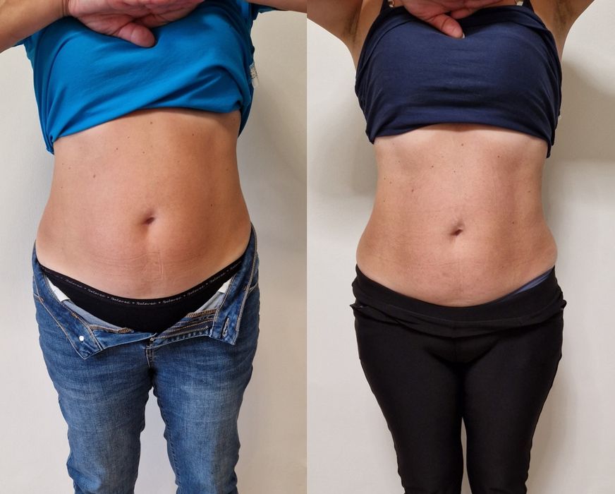 Remodelare cu ultrasunet - LipoSlim & HIFU