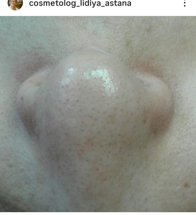 ЧИСТКА ЛИЦА от 7000.