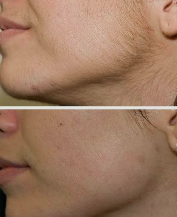 Шугаринг Усть-Каменогорск