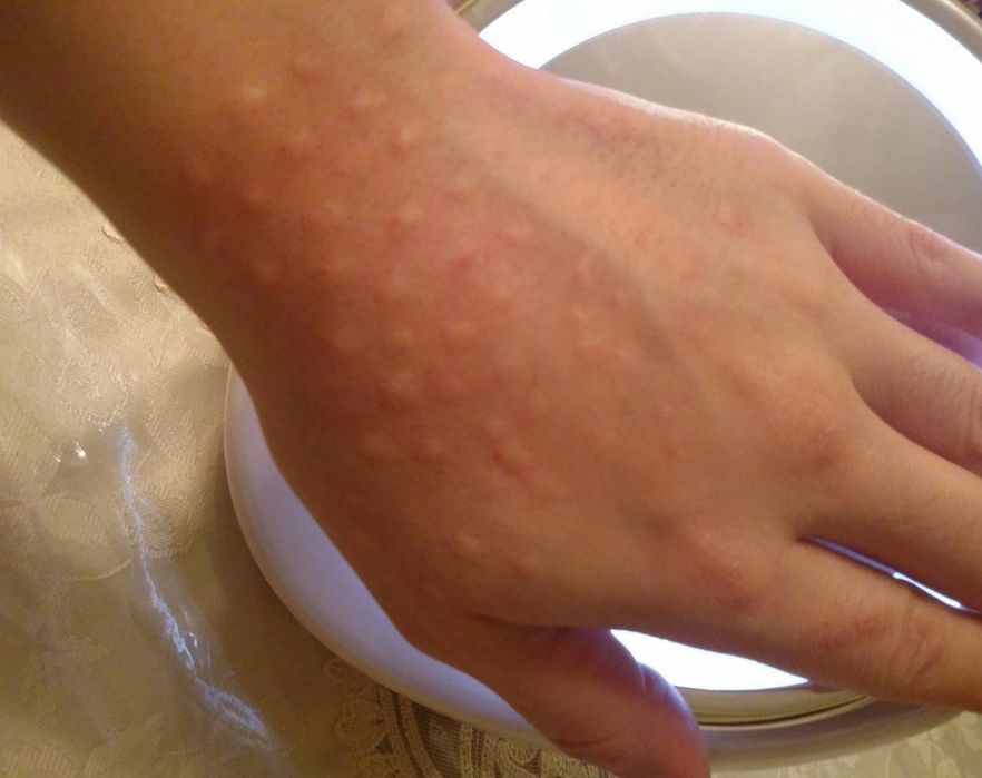 Биоревитализация рук