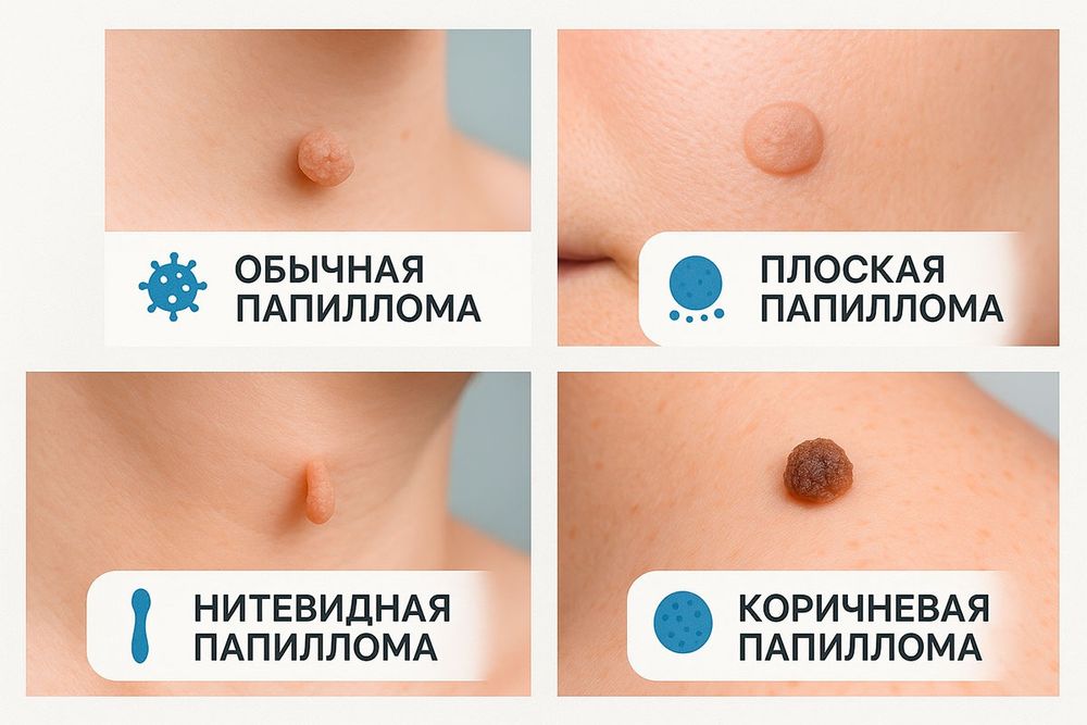 Акция!Удаление папиломы от 25 тысяч