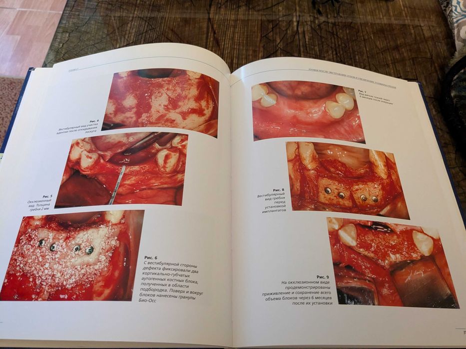 Передовые методики регенерации кости с БИО-ОСС и БИО-ГАЙД