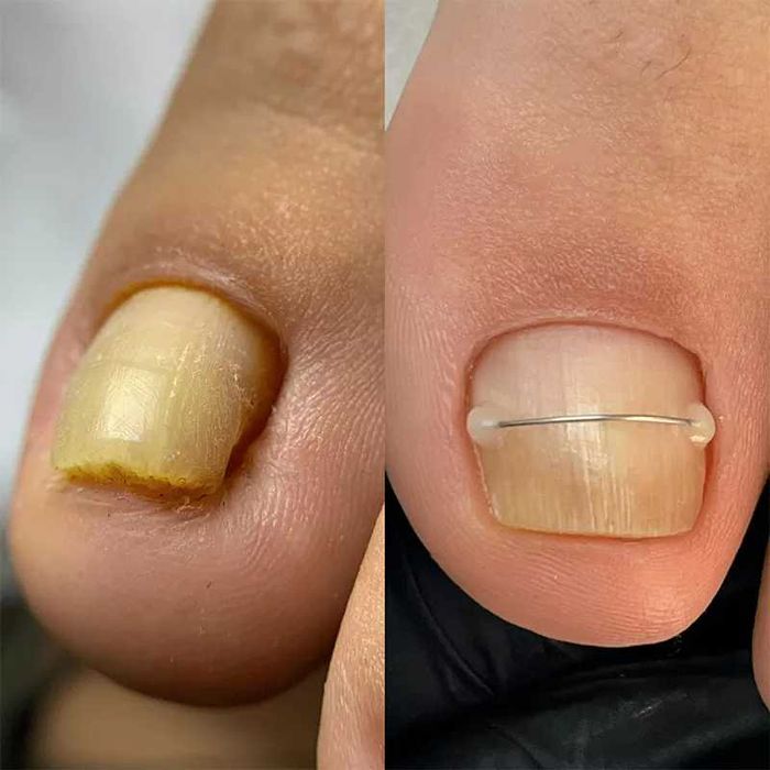 Afectiuni Unghii si Talpi - Podologie doar cu asistenti medicali