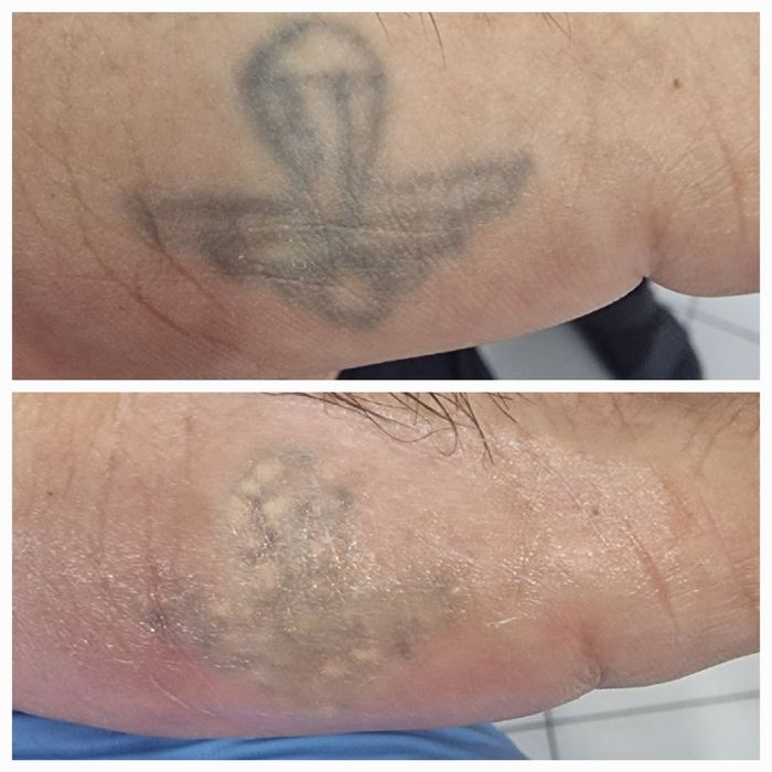 Удаление татуировок  и татуажа