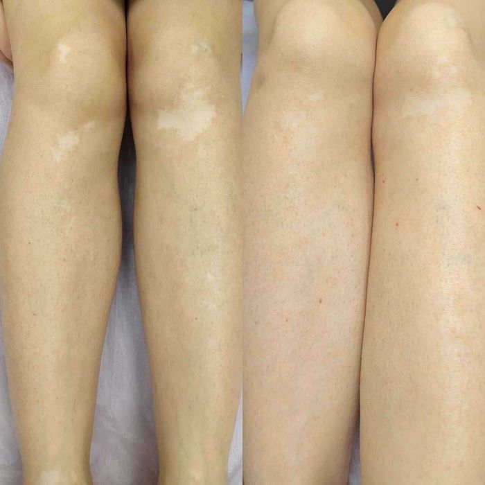 Vitiligo dog'larini kamuflyaj bilan yopish