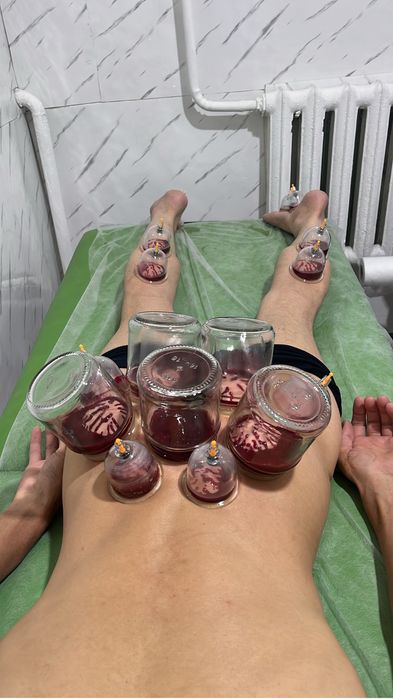 Хиджама и шертпе в городе Алматы