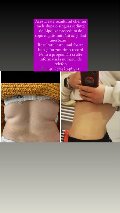 Lipoliză Injectabilă Fără Ac