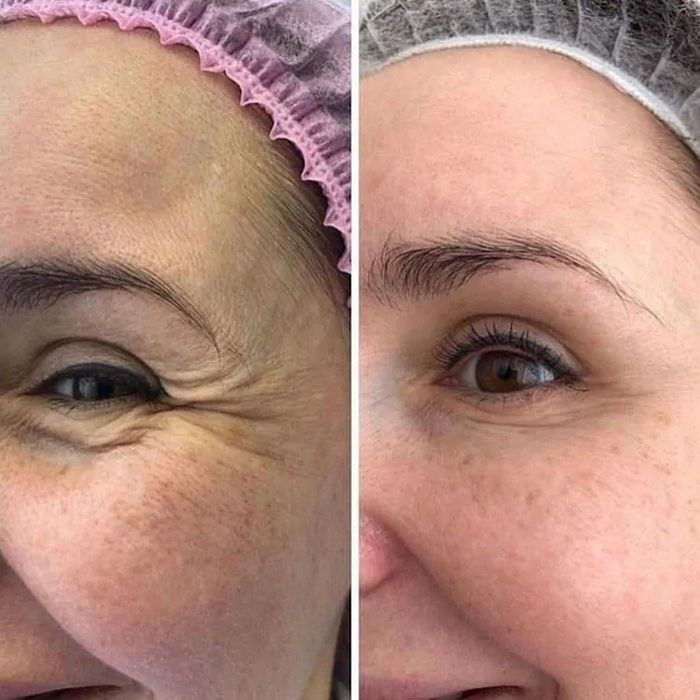 Ботокс и увелечение губ Срочно 50%скидкой места ограничены