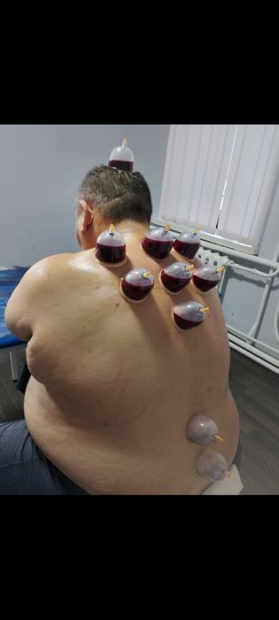 Хиджама профессиональный