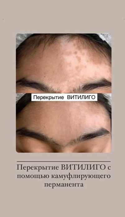 Vitiligo dog'larini kamuflyaj bilan yopish
