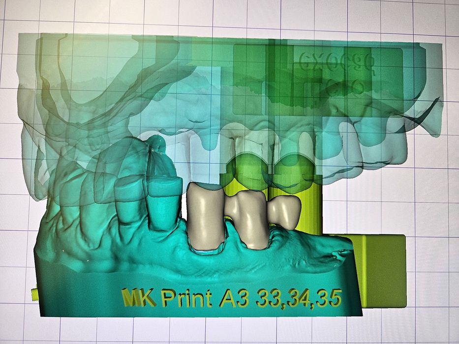 Дигитален Дизайн на Зъбопротезни конструкции от Зъботехник чрез Exocad