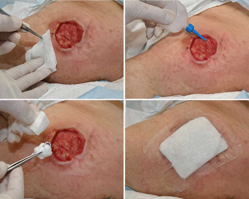 обработка ран и пролижни