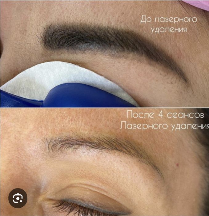 Удаление татуажа бровей.Татуаж учириш.