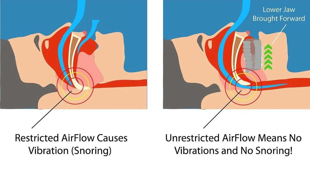 Шина назъбник за уста против хъркане No More Snore