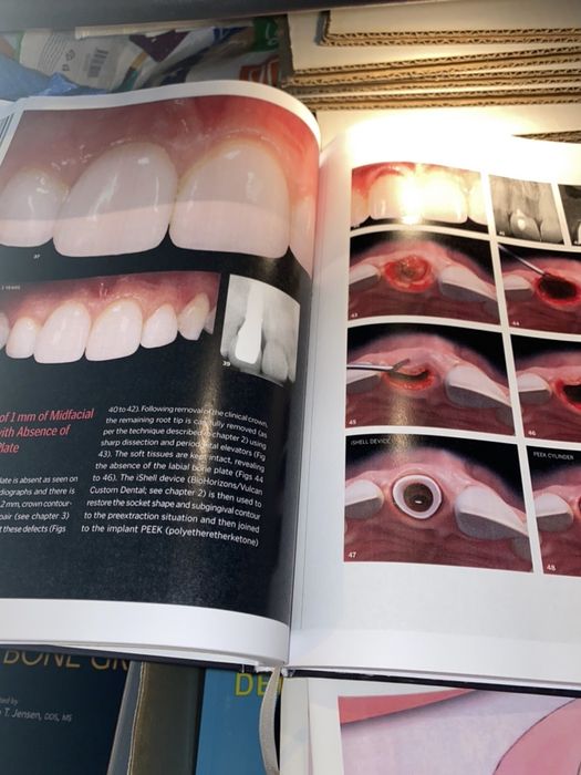 The Single-Tooth Implant J.Chu