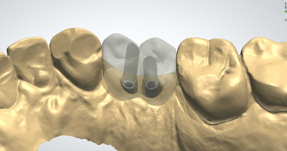 CAD/CAM дизайн |Корони, мостове, барове| 3Shape | Blender for Dental |