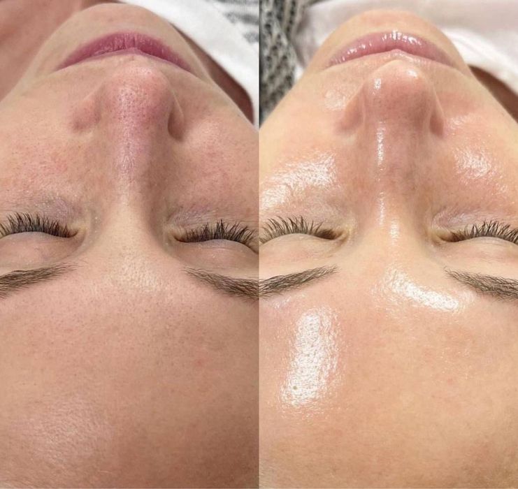 Чистка лица с результатом с первой процедуры