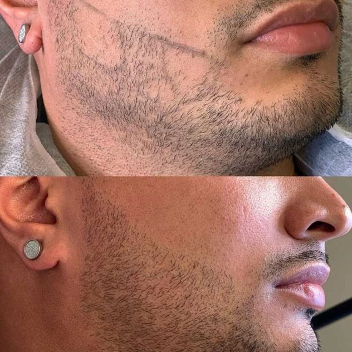 Micropigmentare barba scalp sprancene barbati Bucuresti