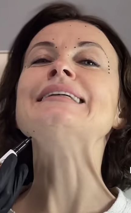 Ботокс,Траптокс,Гипергидроз.Botoks, Traptoks, Qùltiq terlash, gipergid