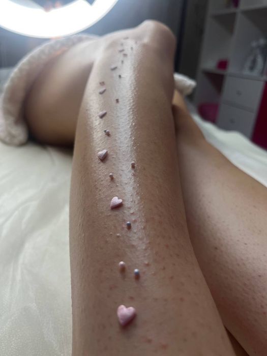 Эластомерная депиляция