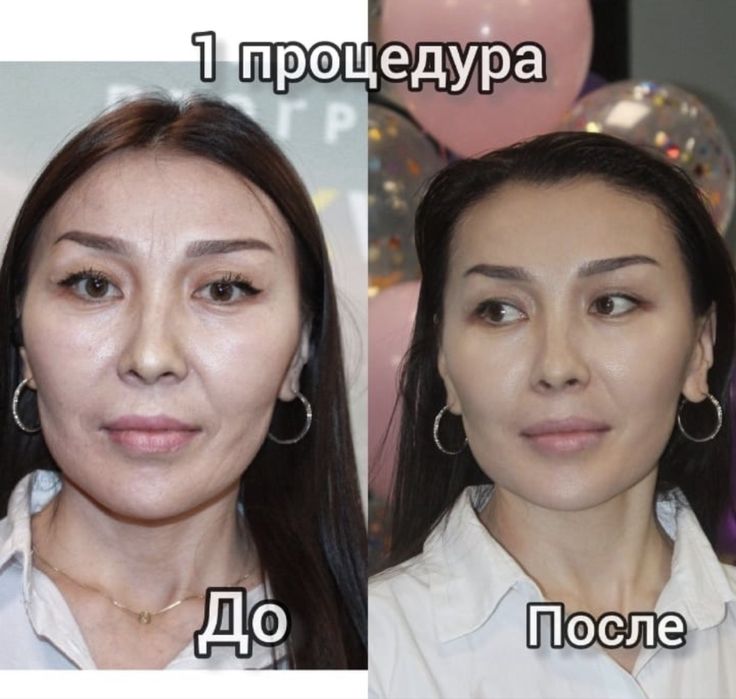 Ультрафонофорез аппарат