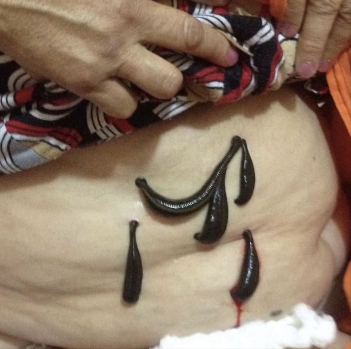 Хиджама, Гирудотерапия (сүлік салу емі)