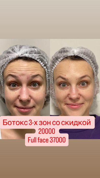 Ботокс Алматы АКЦИЯ