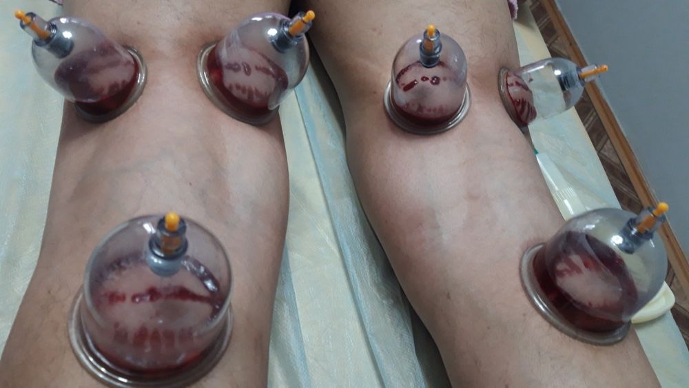 Хиджама. Шертпе. Пиявки