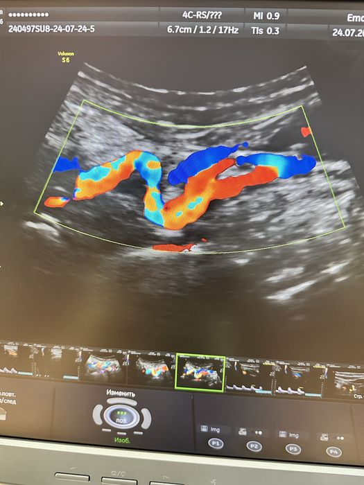 УЗИ (Уздг) сосудов