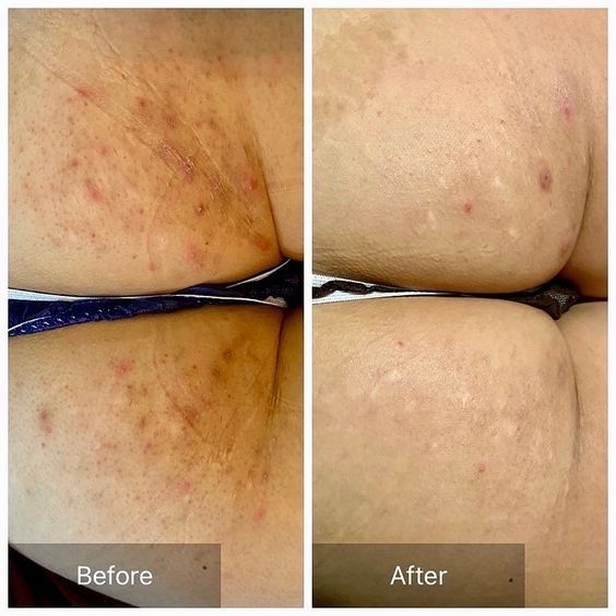 Обучение лазерной эпиляции