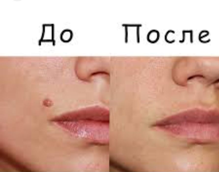 Удаление папиломы