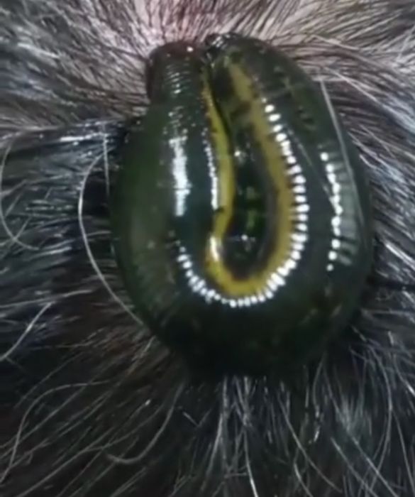 Лечение пиявками . Обучение