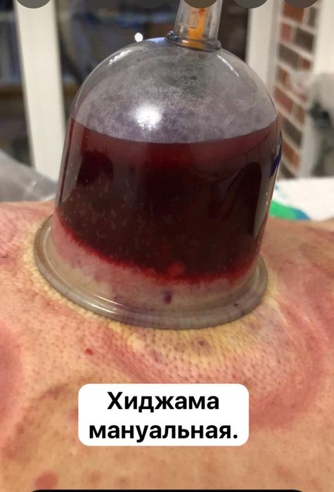 Хиджама мануальная.