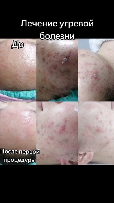 Лечение угревой болезни