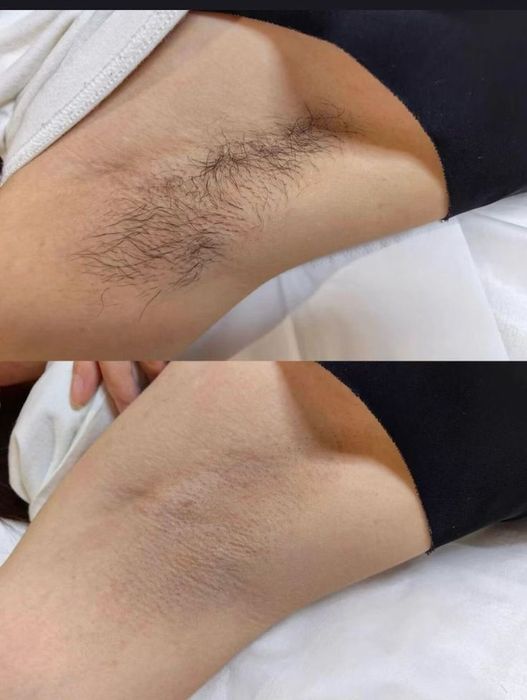 Vosk depilyatsiya | SPA depilyatsiya | Italwax master