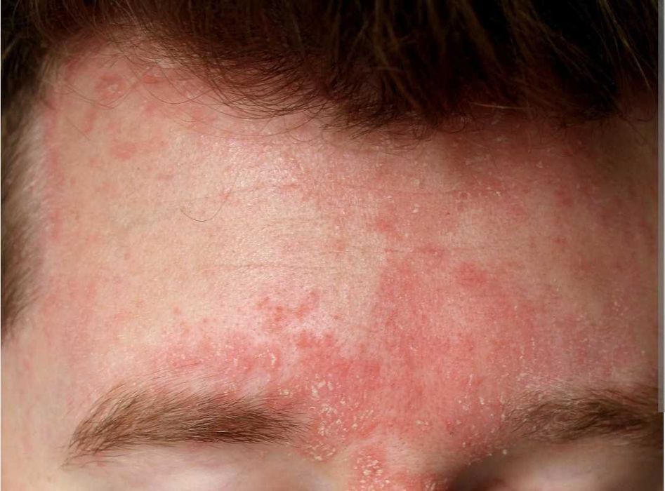 Себореен дерматит , себорея , крем , лечение , терапия , пъпки