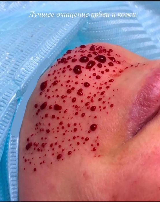 Хиджама Капиляротеропия